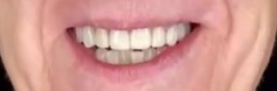 Foto detalle después