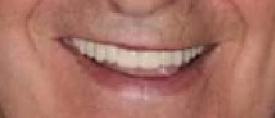 Foto detalle después