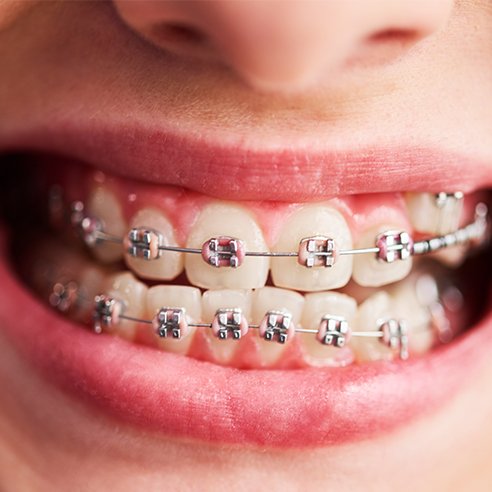 ¿Cuánto dura el tratamiento?